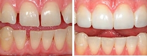 Tooth Bonding To Improve Your Smile